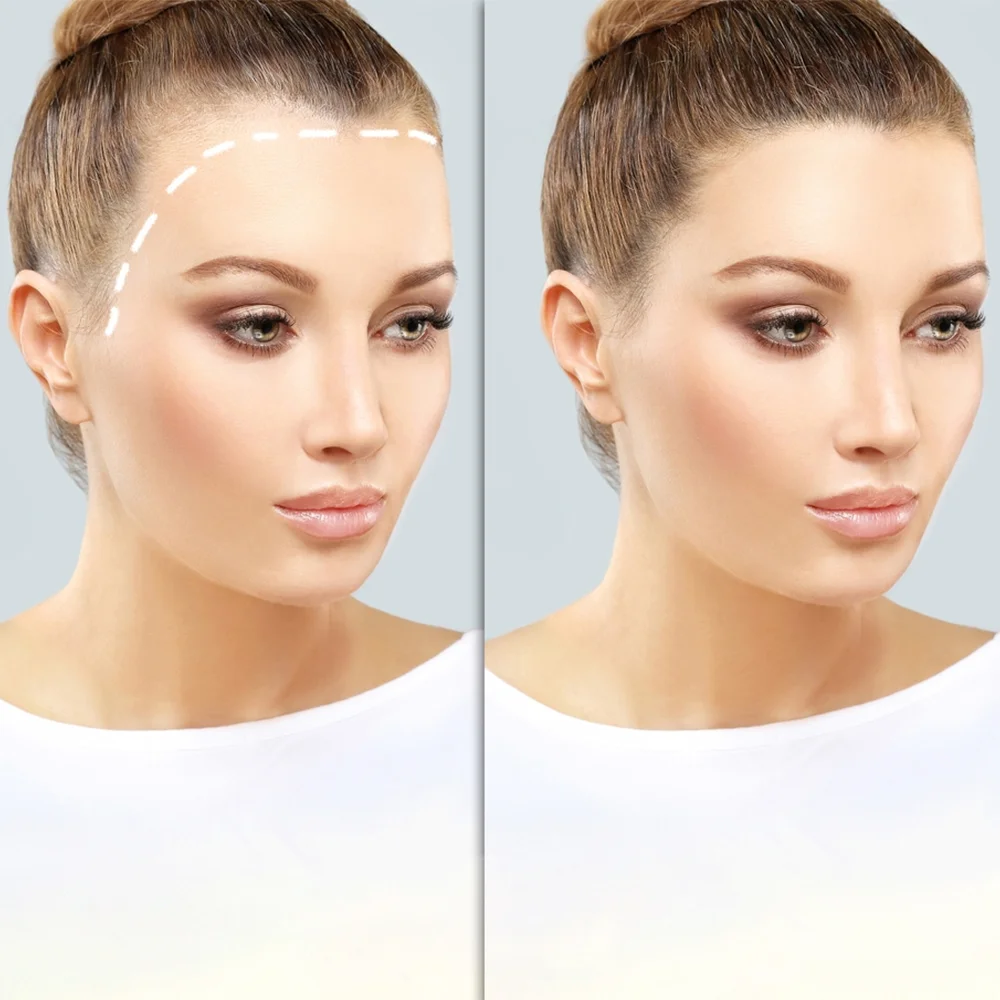 Hair Transplant in Turkey: Top 5 Reasons to Choose Vera Clinic Hair Transplant in Turkey: Top 5 Reasons to Choose Vera Clinic